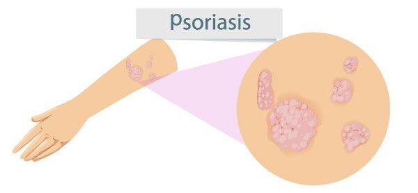 ¿Qué es la psoriasis?