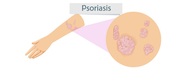 ¿qué Es La Psoriasis Lapharcon 