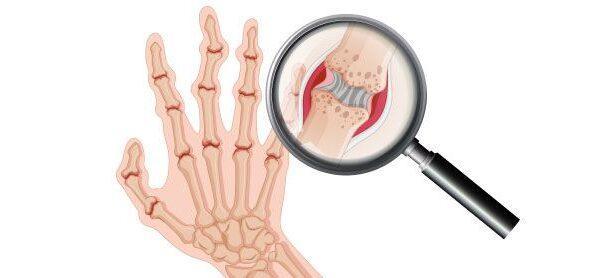 Día mundial de la osteoporosis